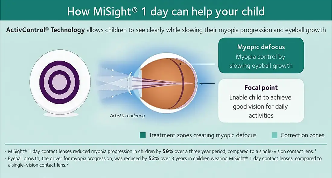 How Misight 1 Day Can Help Your Child